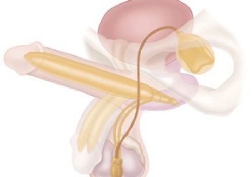 Understanding Penile Implants: Everything You Need to Know